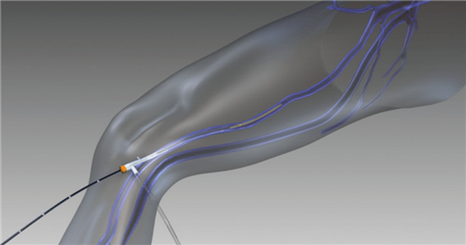 radiofrekvencijska obliteracija za proširene vene