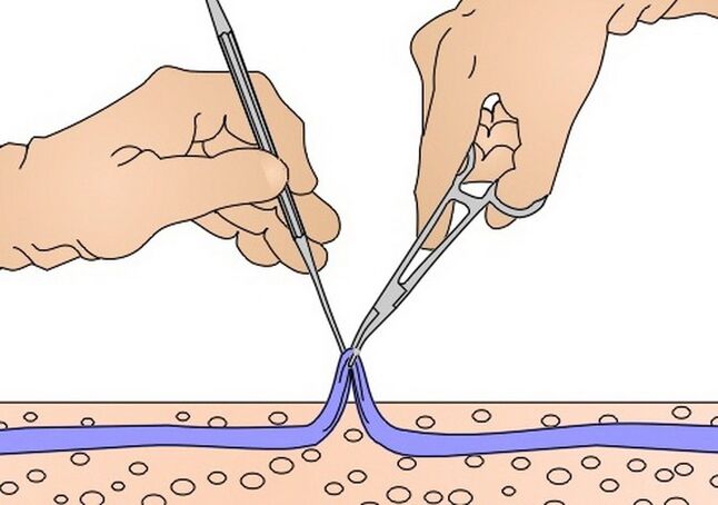 uklanjanje vena za proširene vene